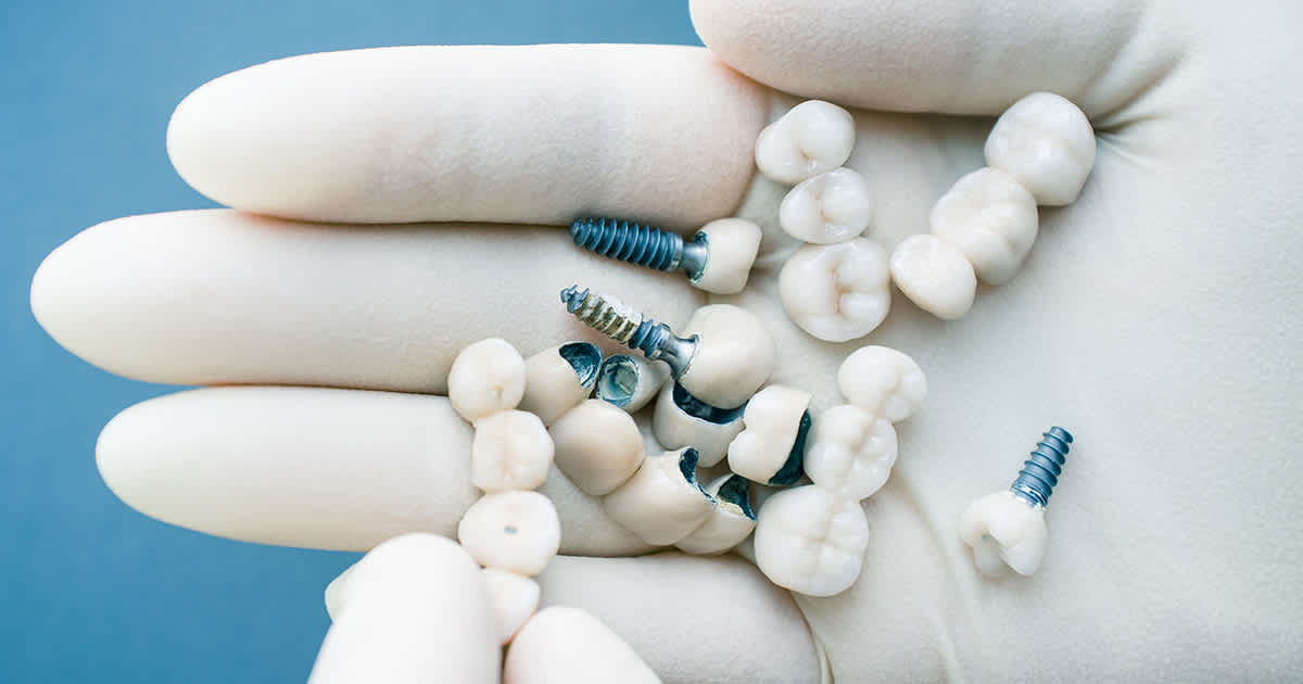 dental implants in a gloved dentists hand