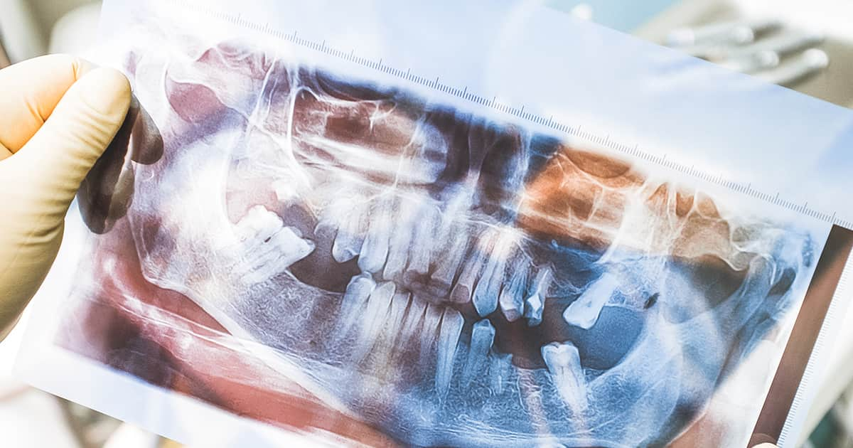 missing teeth on a dental xray