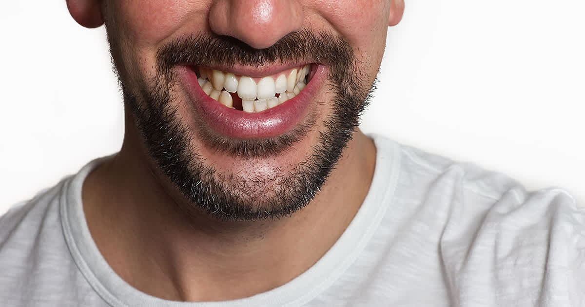 man with one missing tooth in his mouth