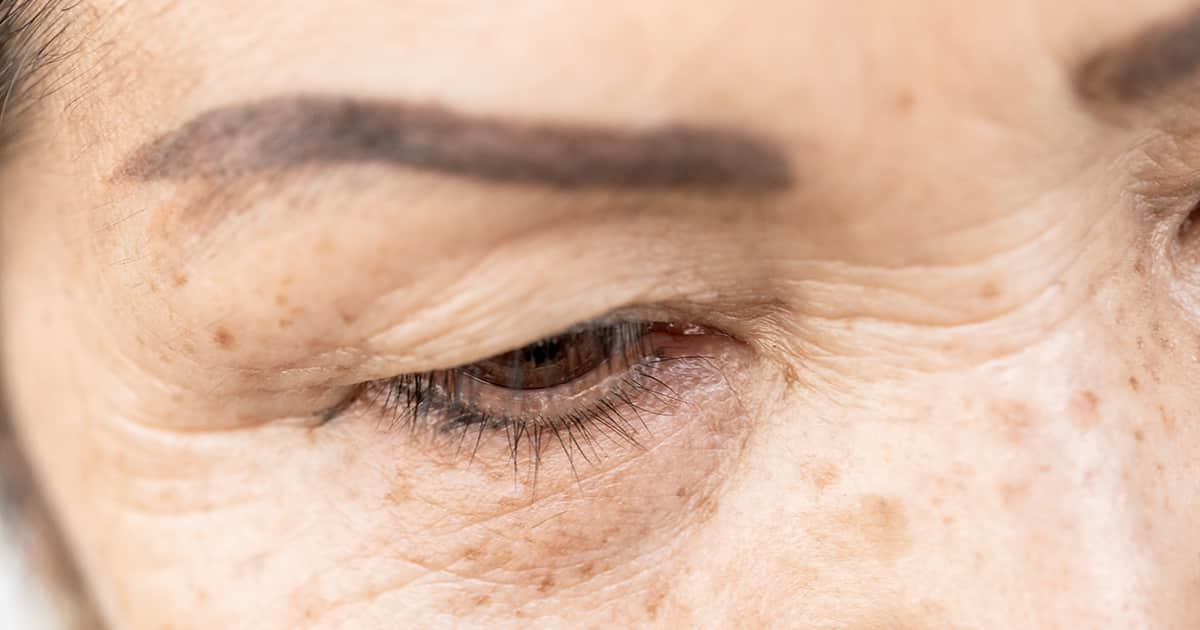 a woman with wrinkles in her eye area and hollow upper eyelids