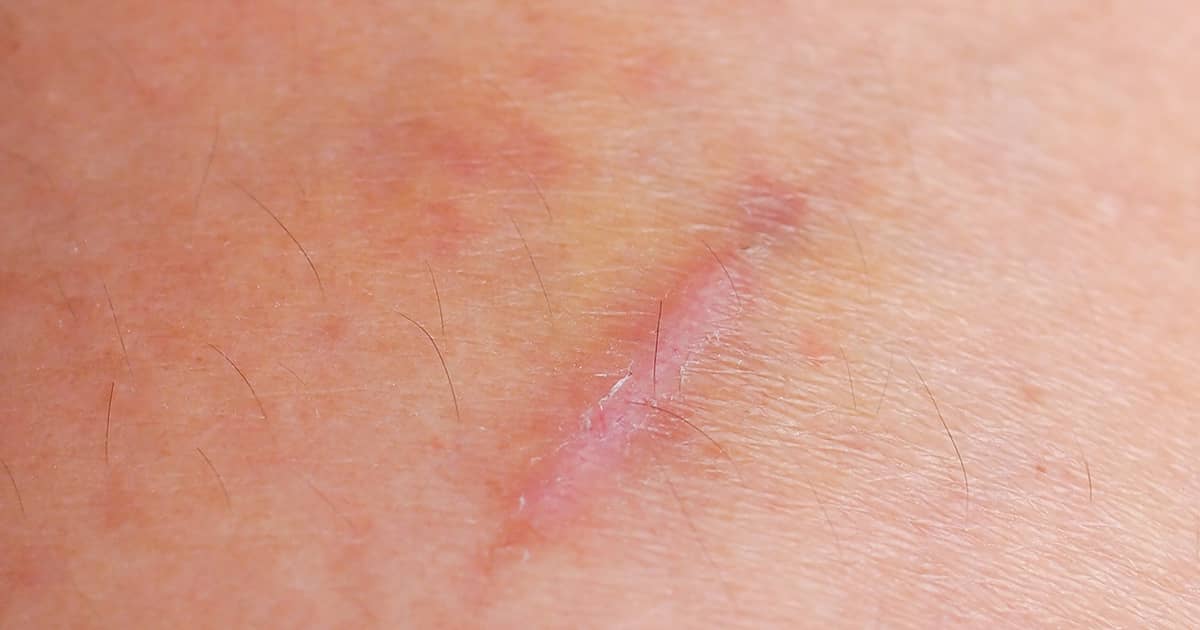 a keloid on a patch of skin