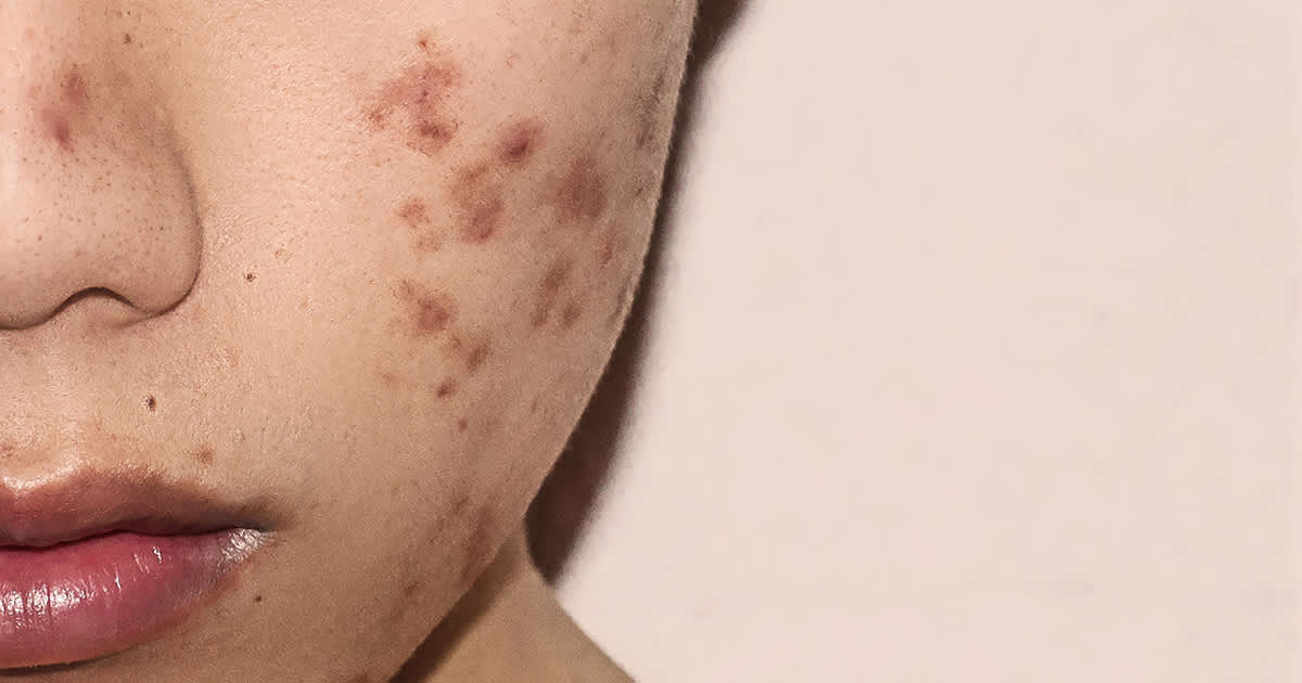 acne on a young womans face