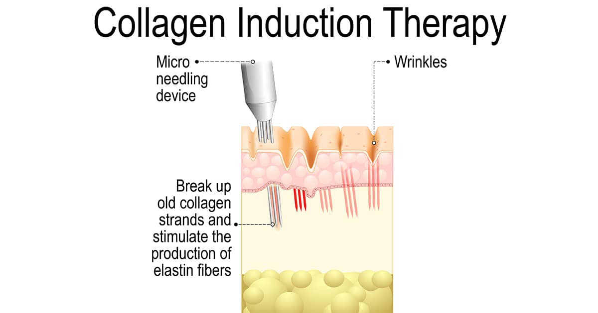 medical illustration of skin undergoing collagen induction therapy