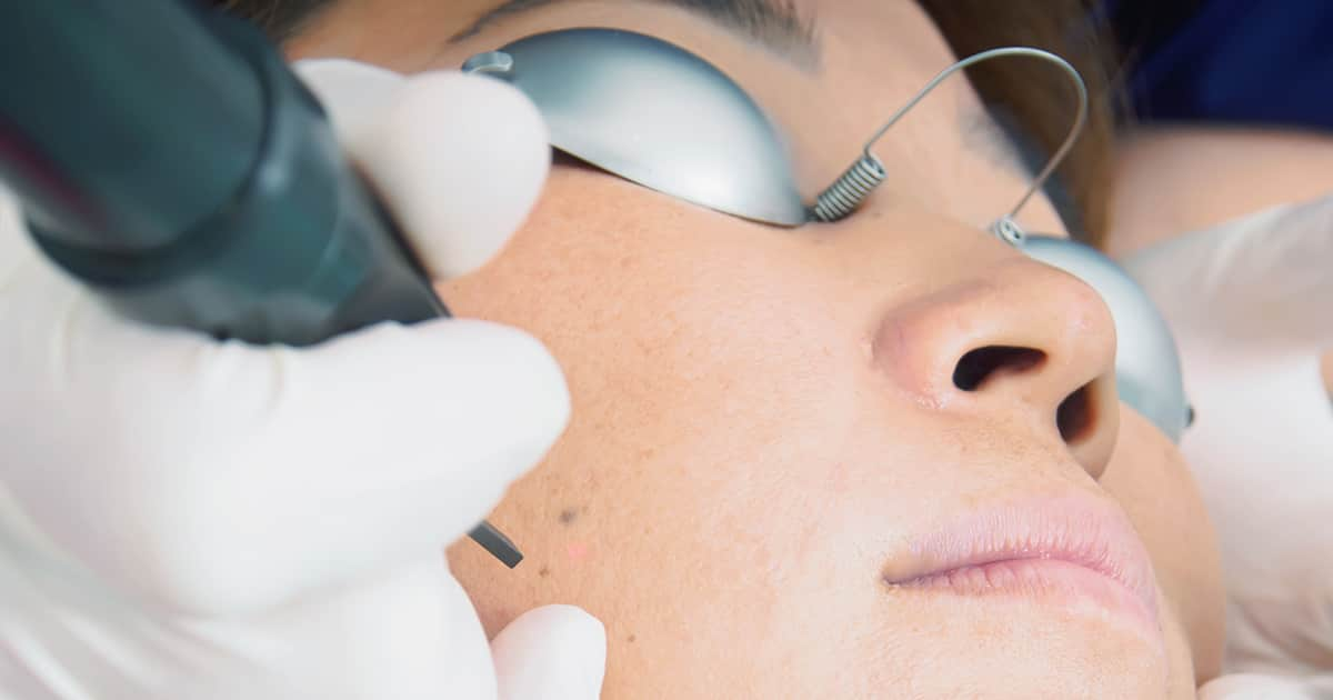 a woman having pigmentation removed from her cheek