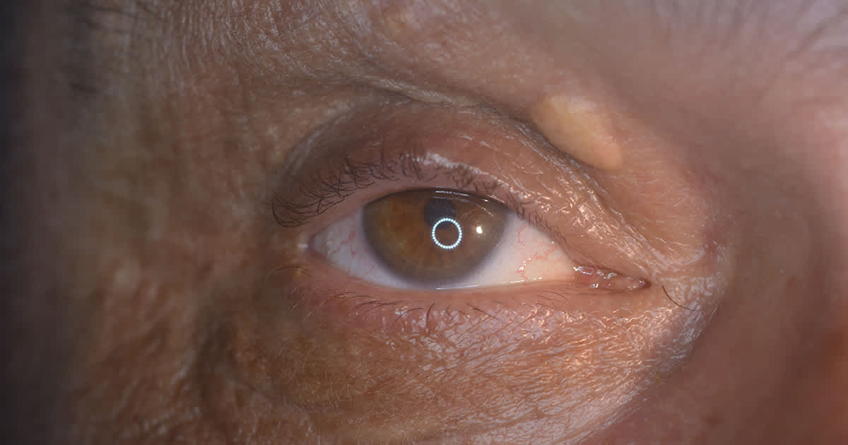 a xanthelasma on an eye