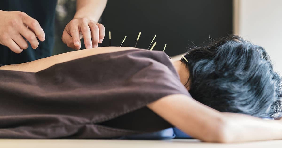 patient in a robe receiving acupuncture