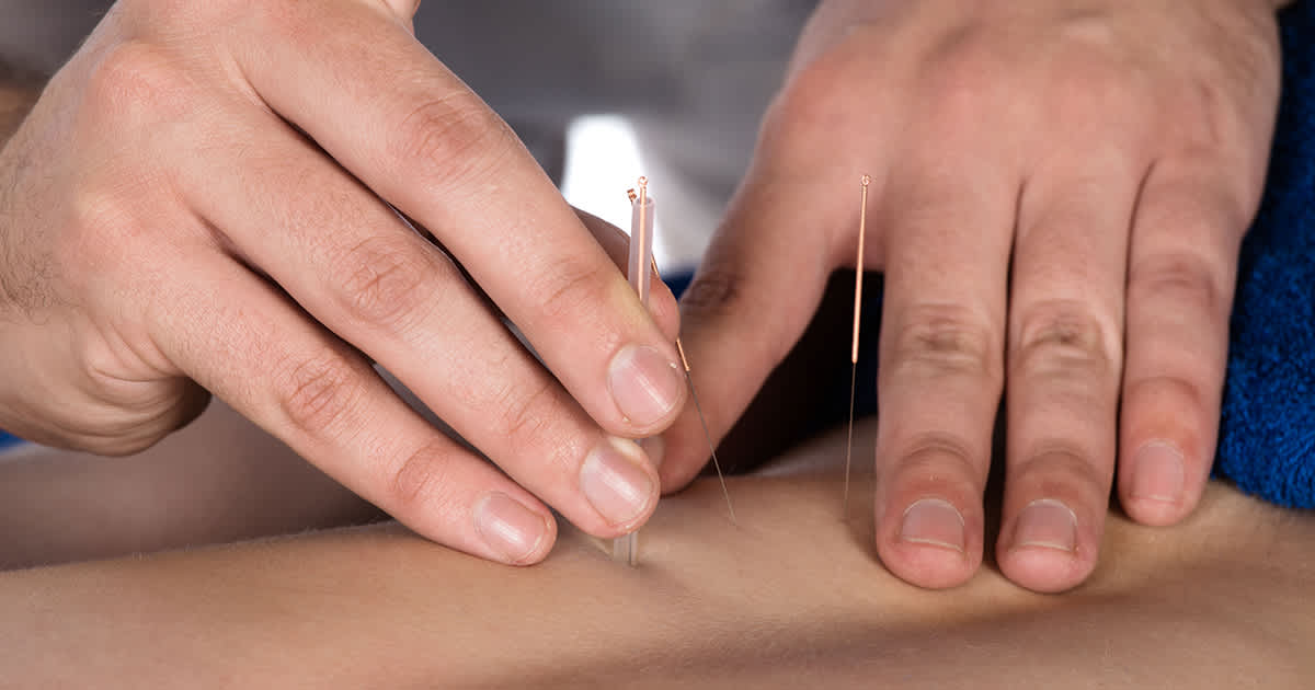 acupuncture needles on back