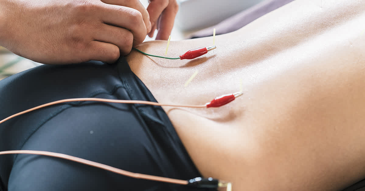 electric current with acupuncture