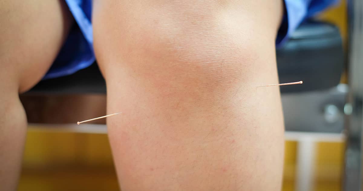 acupuncture in the knee