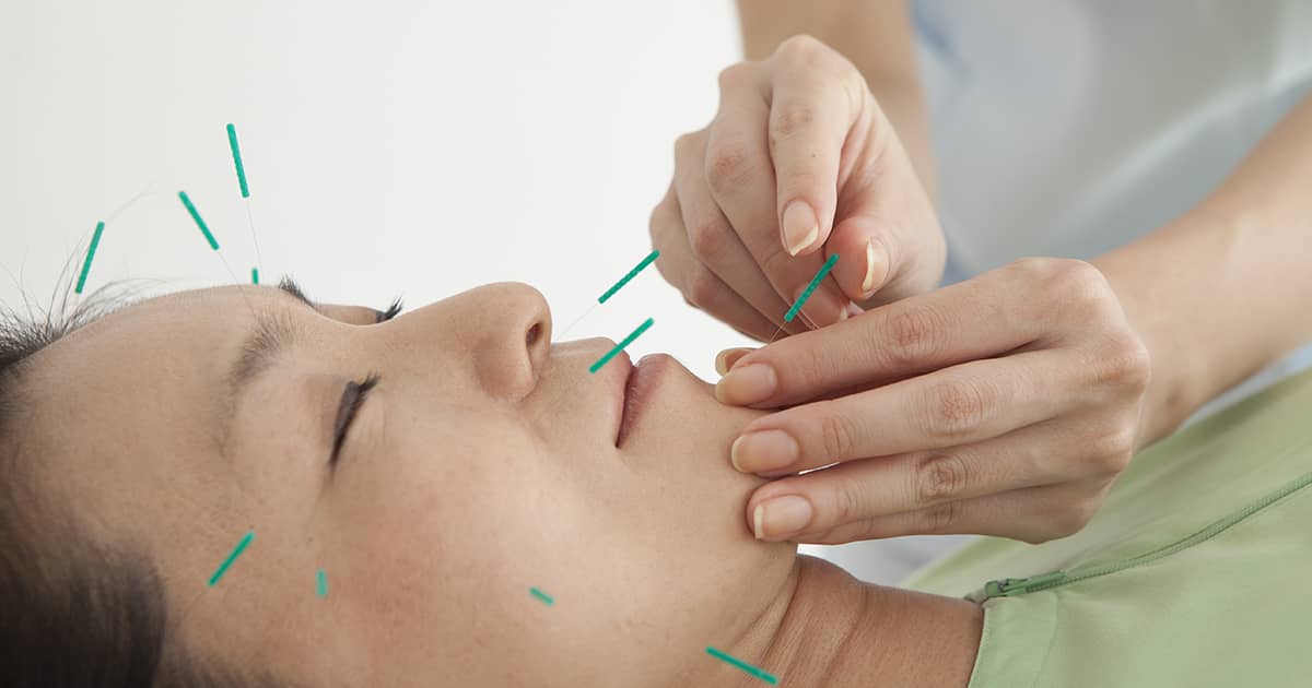 facial acupuncture