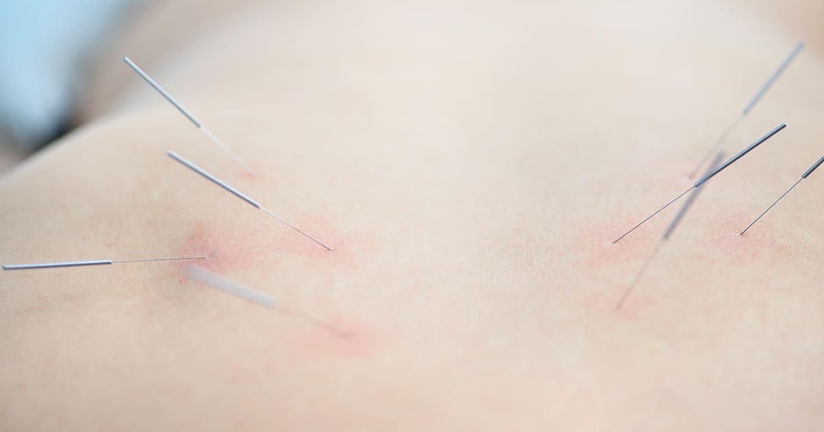 acupuncture of the upper back