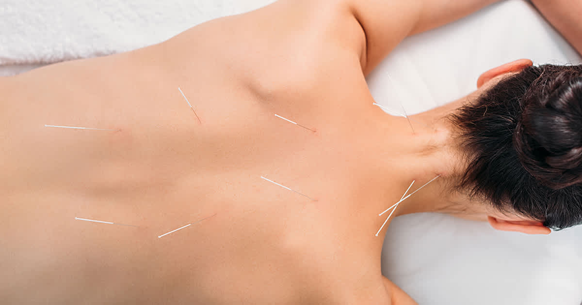 acupuncture on a womans back