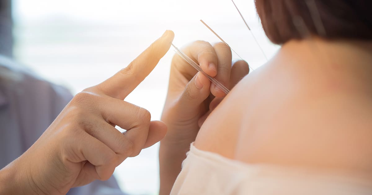 acupuncture on sitting patient