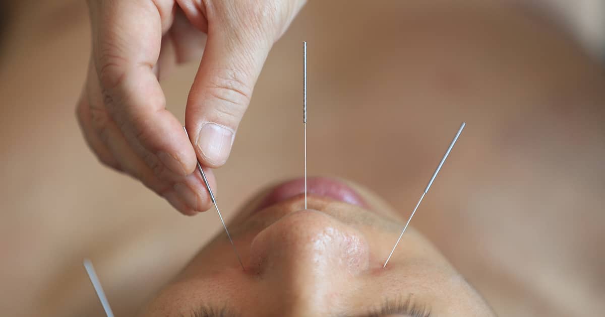 face acupuncture