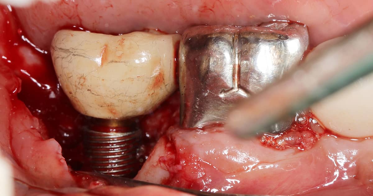 infection near a dental implant