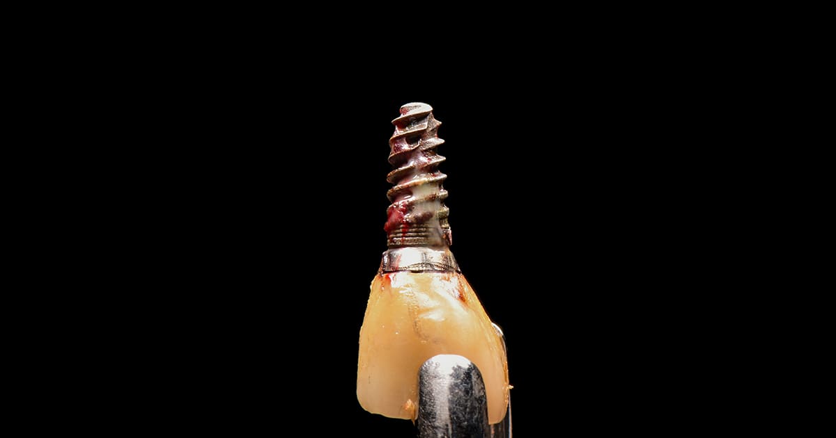 dental implant removed from a mouth