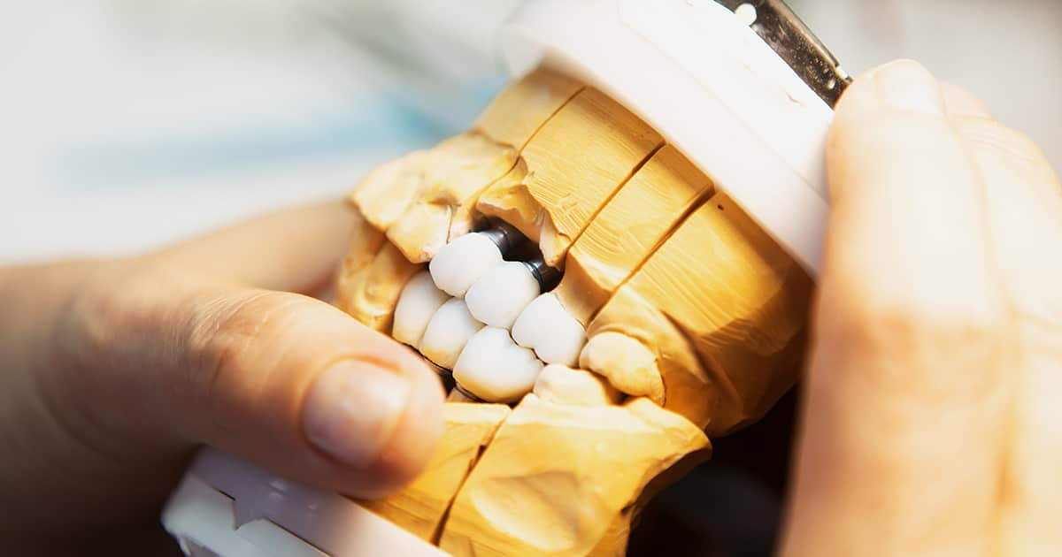 dental implant model in a clinic