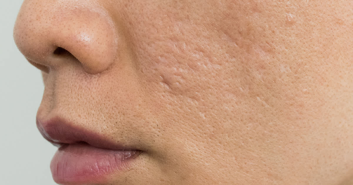 rolling acne scars on a face