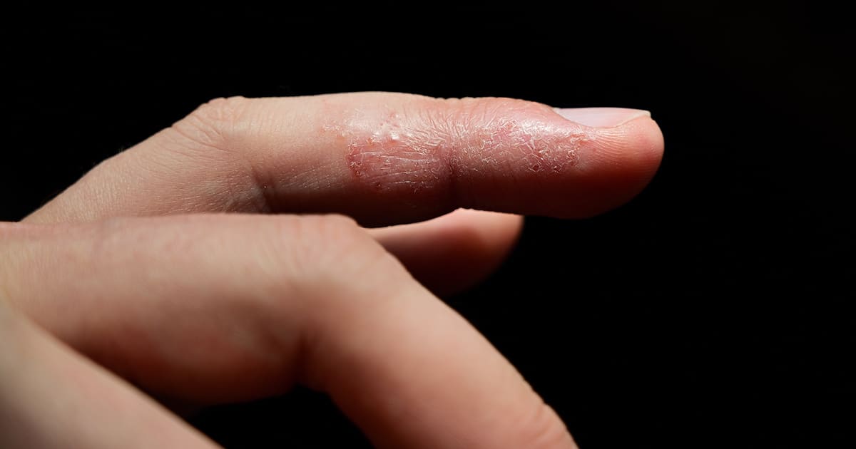 eczema on a finger