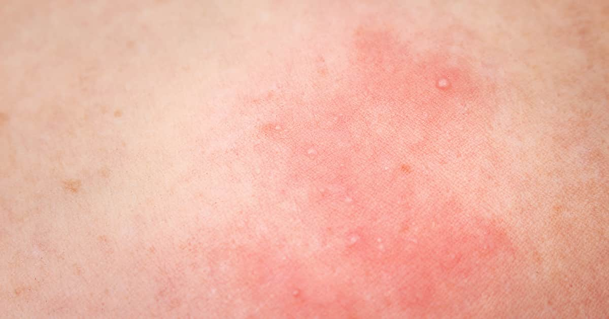 skin rash