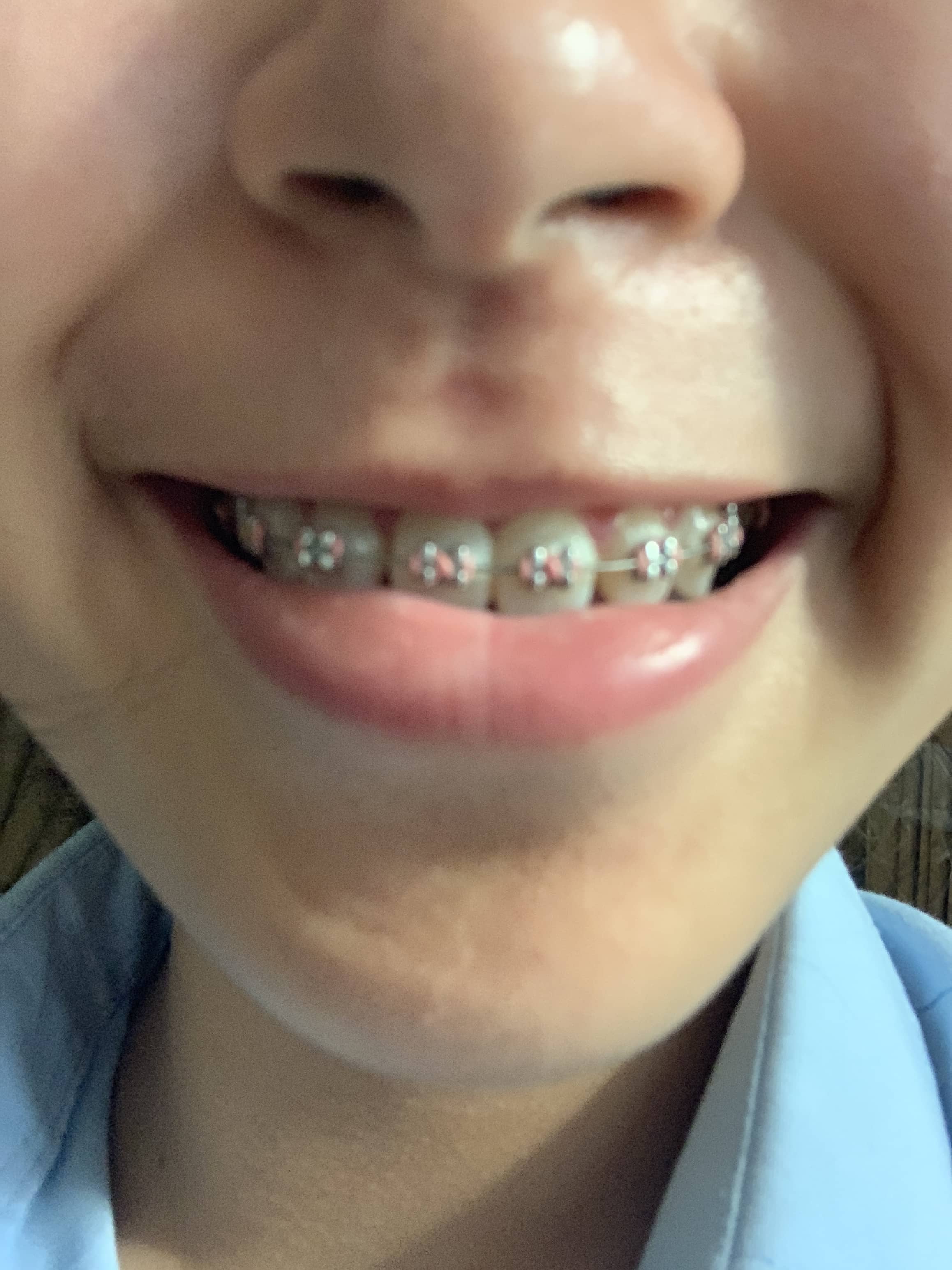 First time braces
