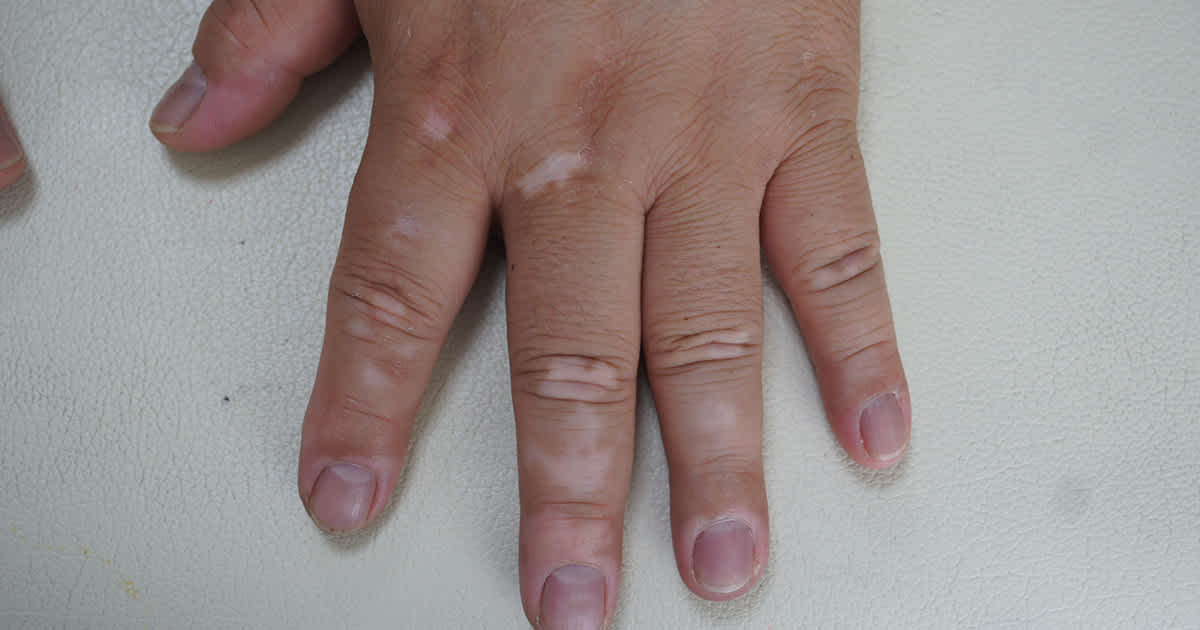 a childs hand with vitiligo spots