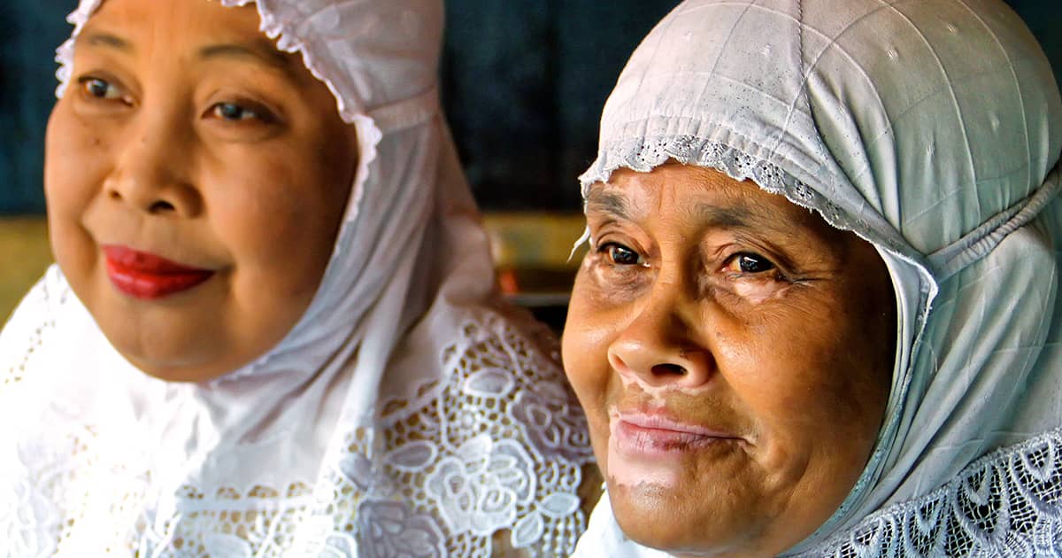 two muslim women one with vitiligo on face