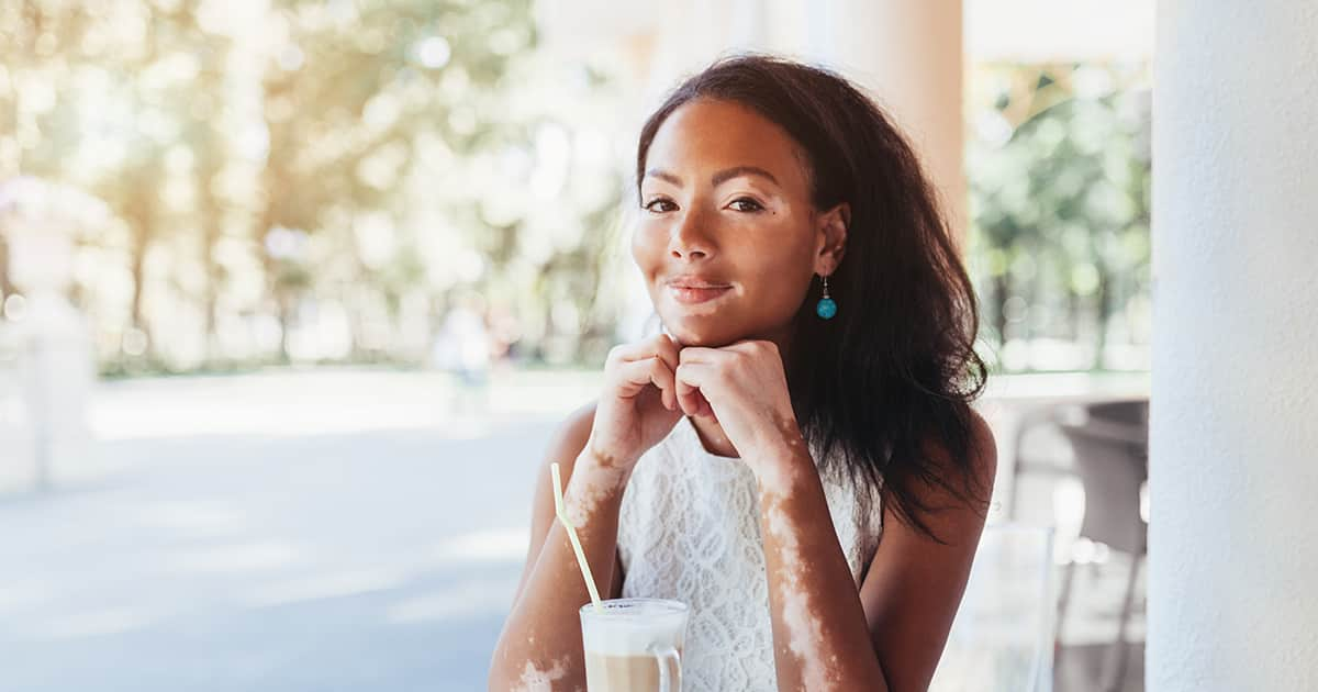 a confident young lady with vitiligo