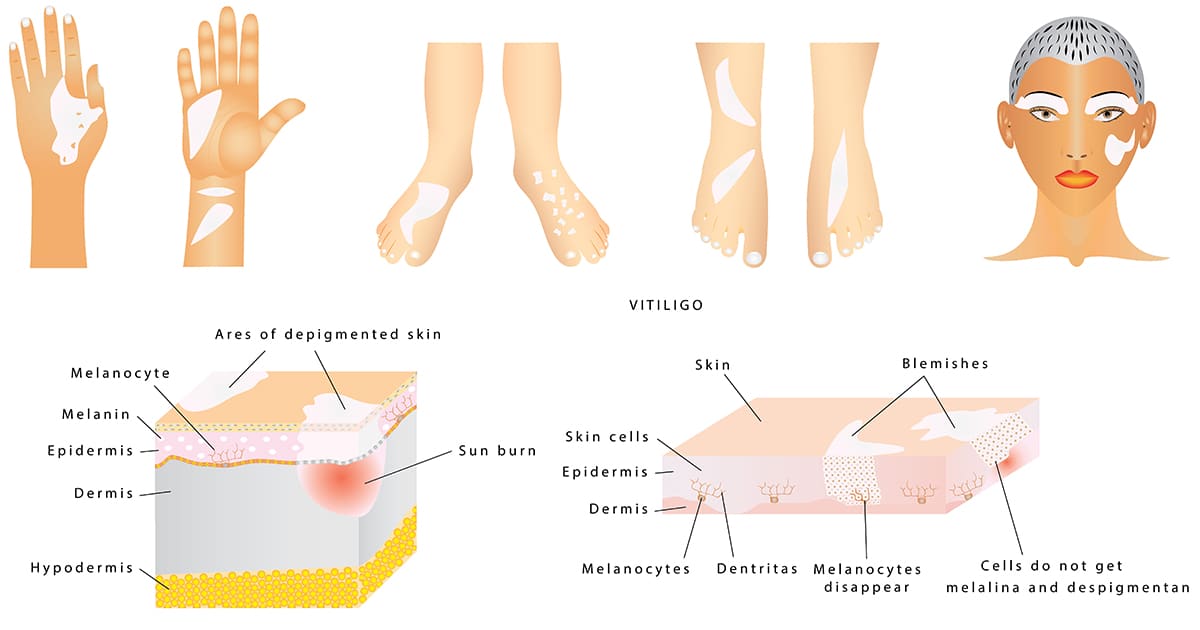 illustration of parts of body with vitiligo