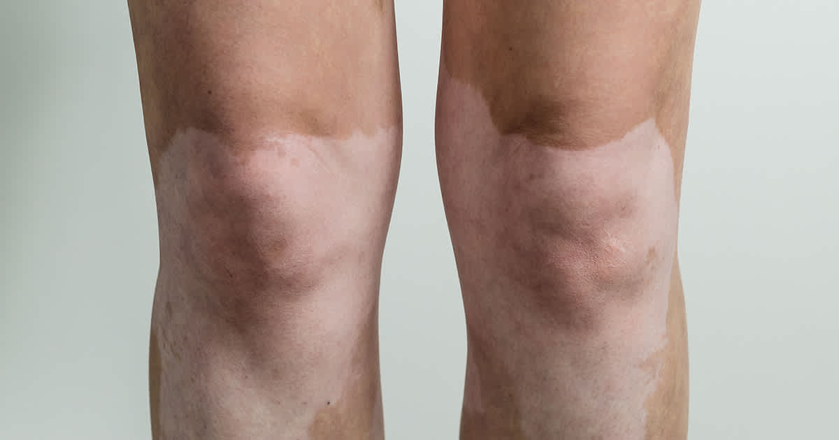 knees with vitiligo patches