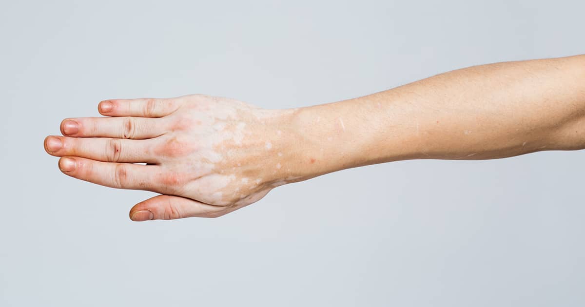 a hand with vitiligo patches
