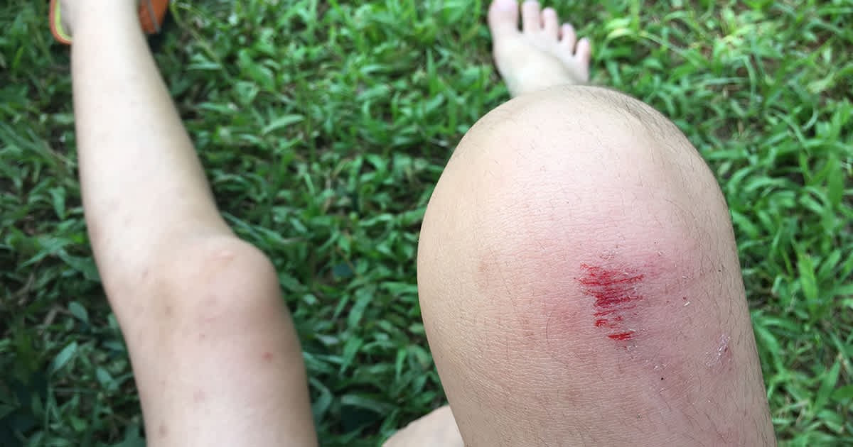 grazed knee on grass