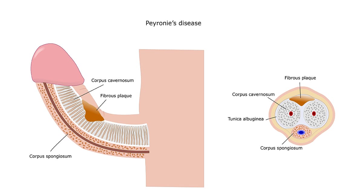 an illustration of peyronies disease