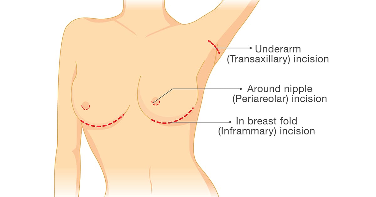 illustration of incision points on breast