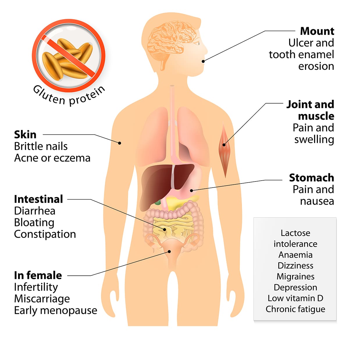 illustration on the symptoms of celiac disease on the human anatomy