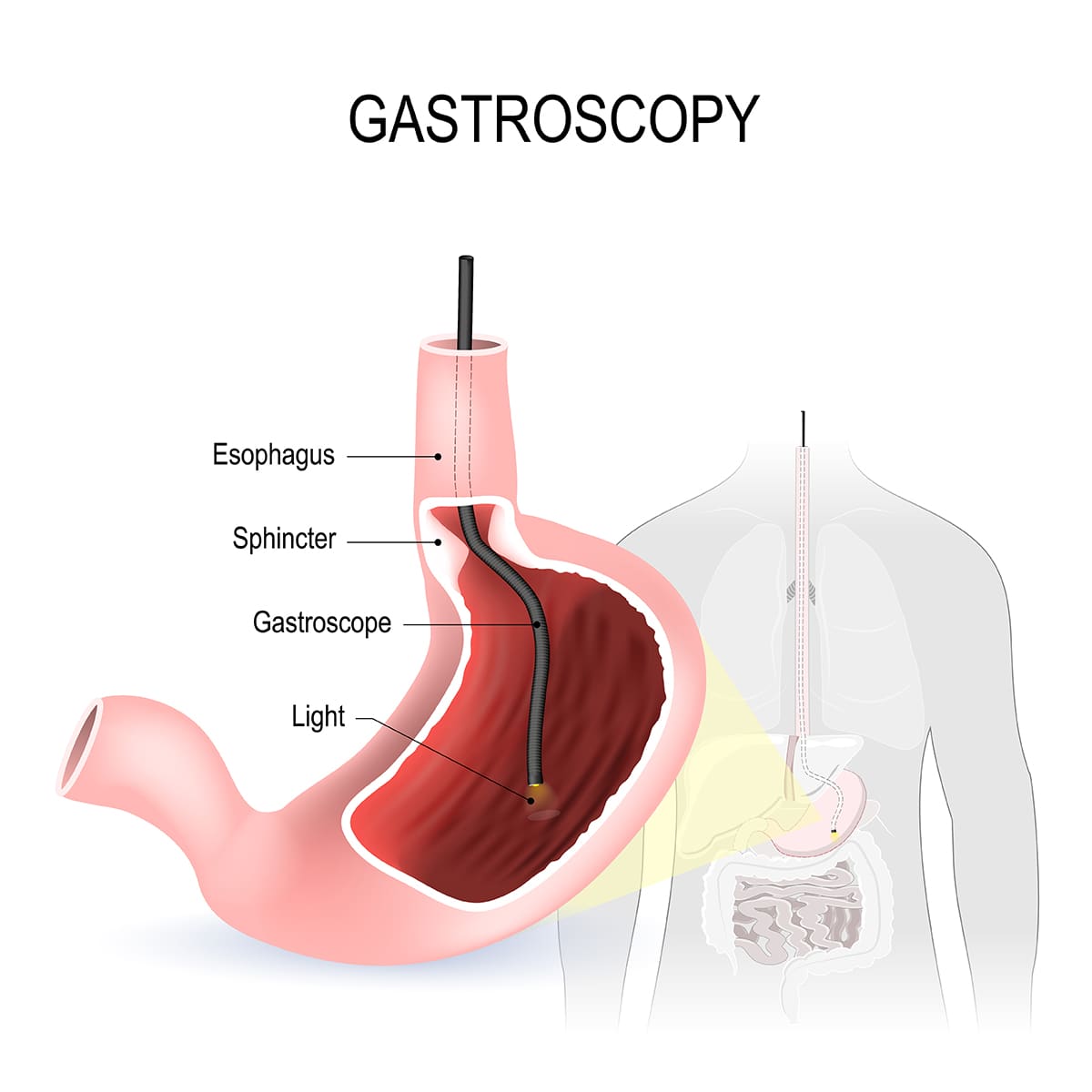 illustration of a gastroscopy procedure