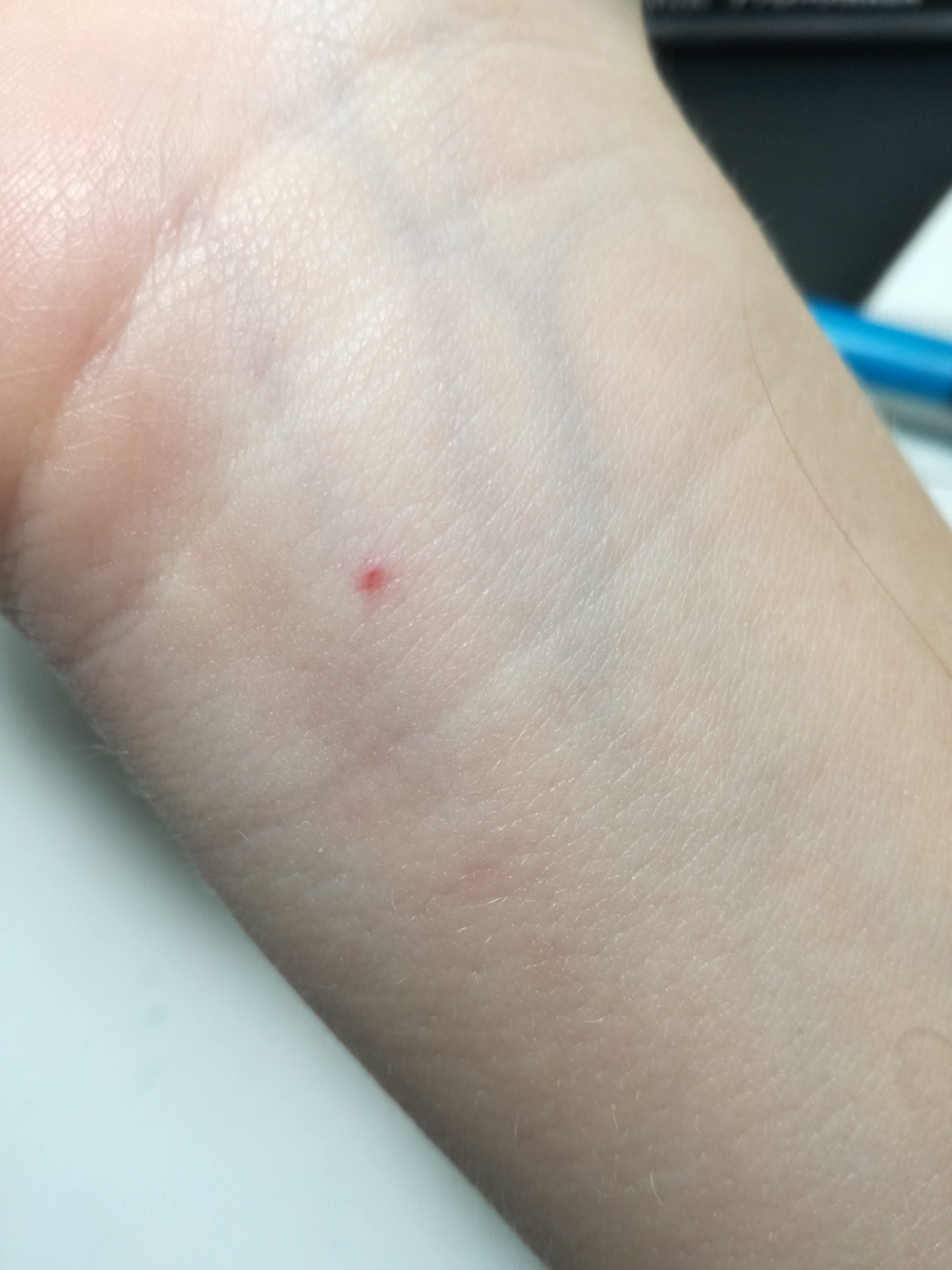 what-could-cause-these-red-spots-to-continuously-develop-on-my-hands