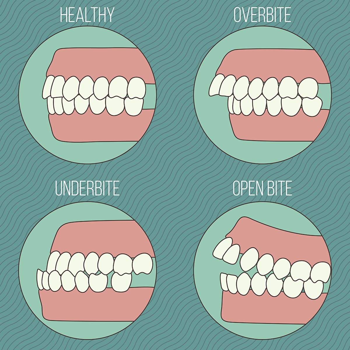 illustration of different types of malocclusions