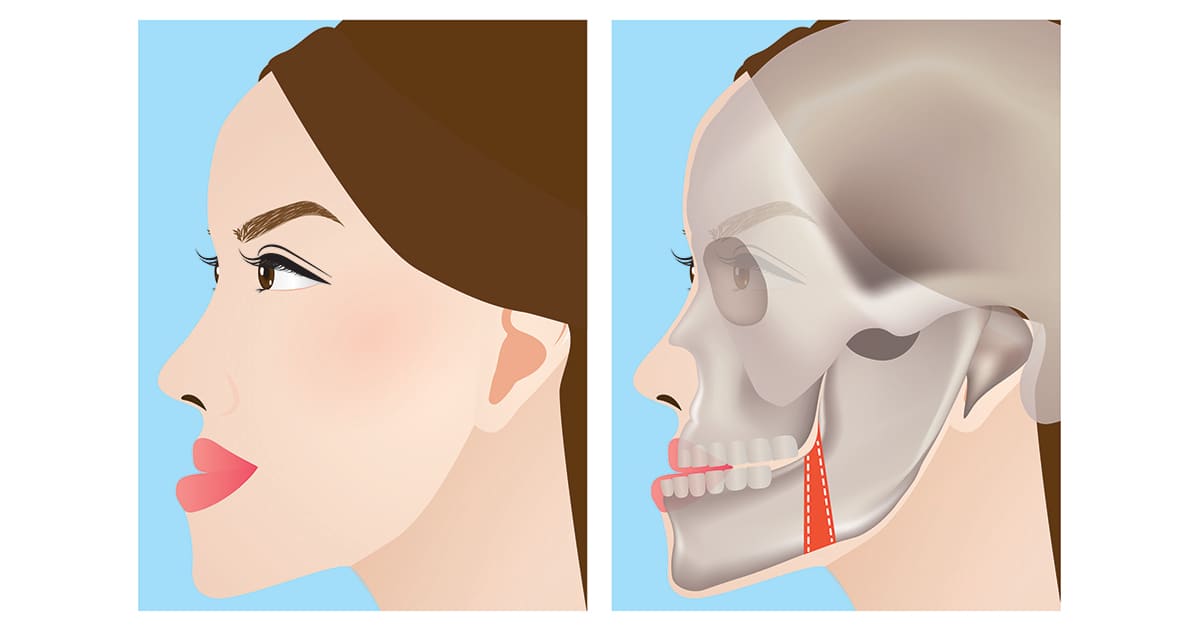 illustration of a jaw protrusion and incision point for jaw surgery