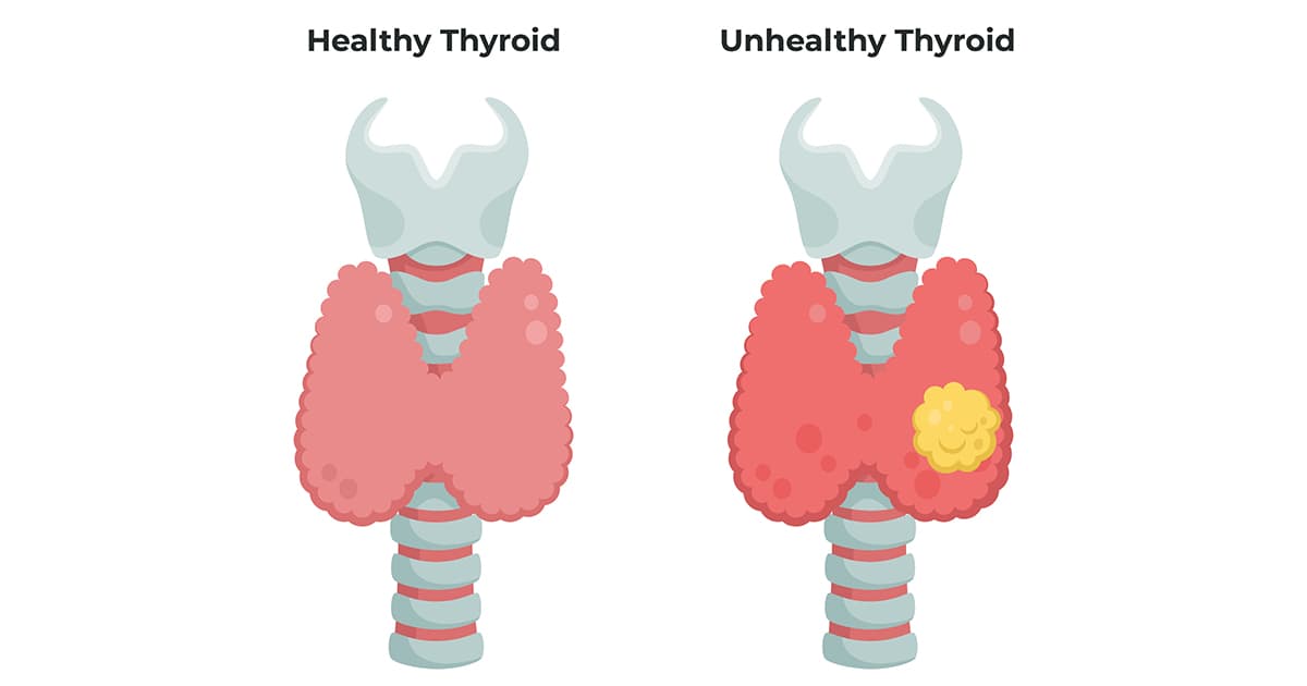 illustration of a healthy and unhealthy thyroid