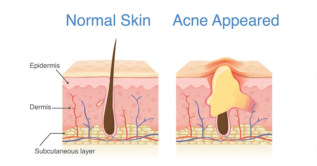 illustration of normal and acne-skin