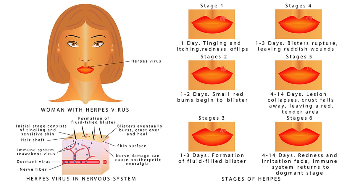 illustration and explanation of stages of herpes virus