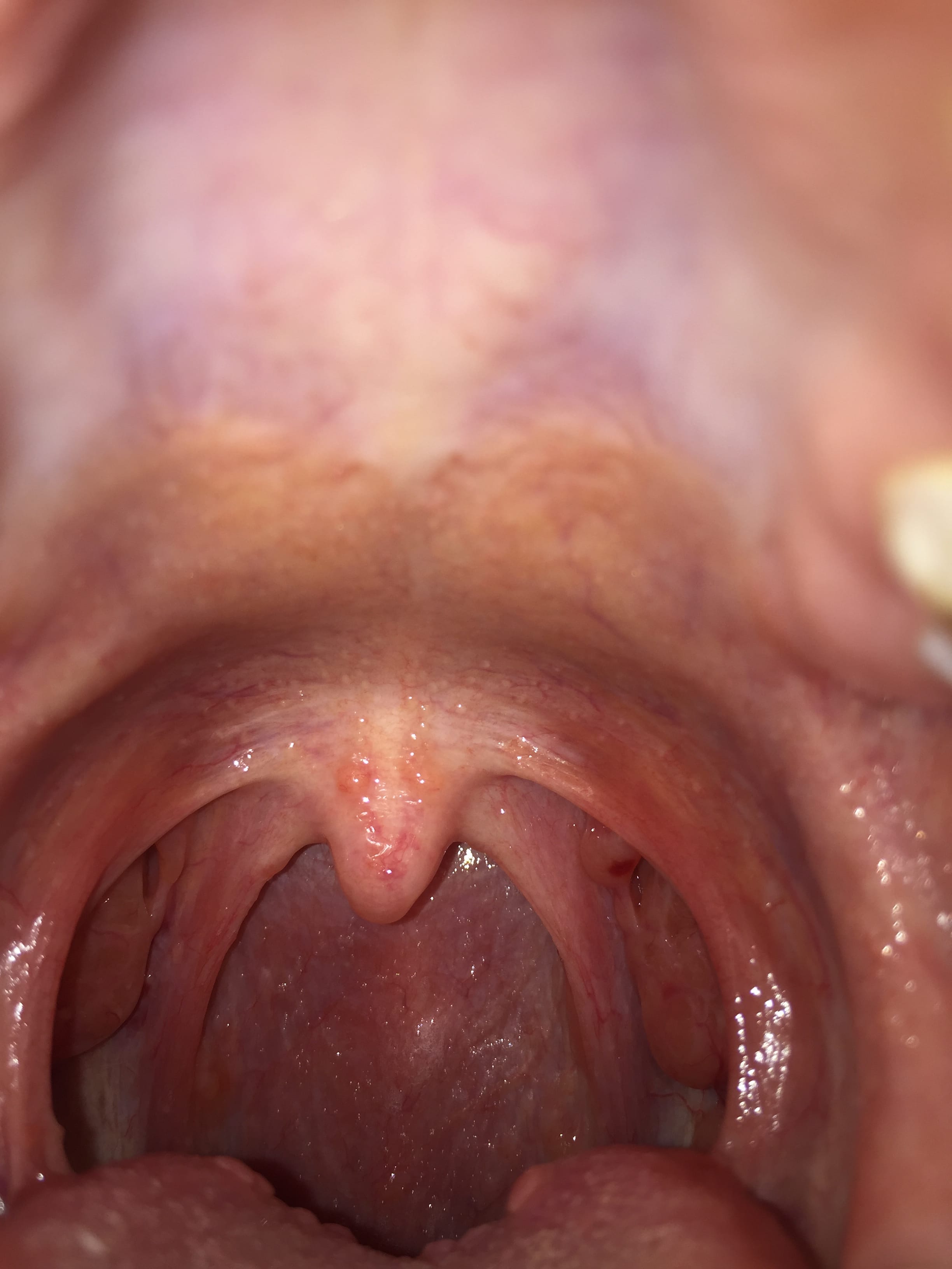 normal throat bumps