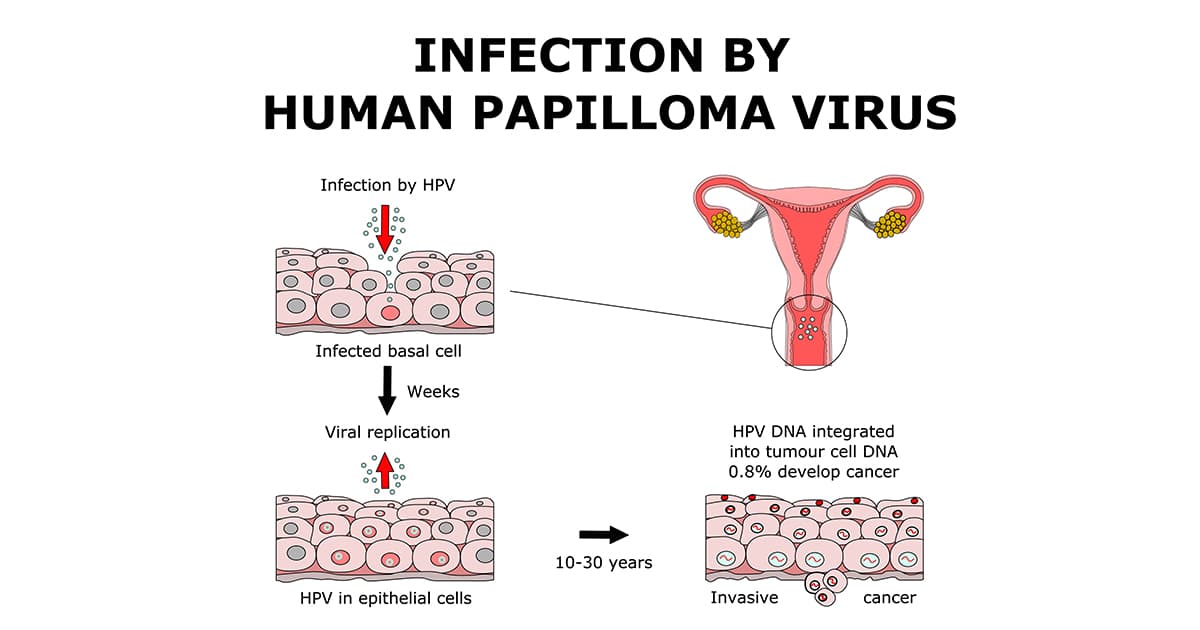 illustration of infection by hpv