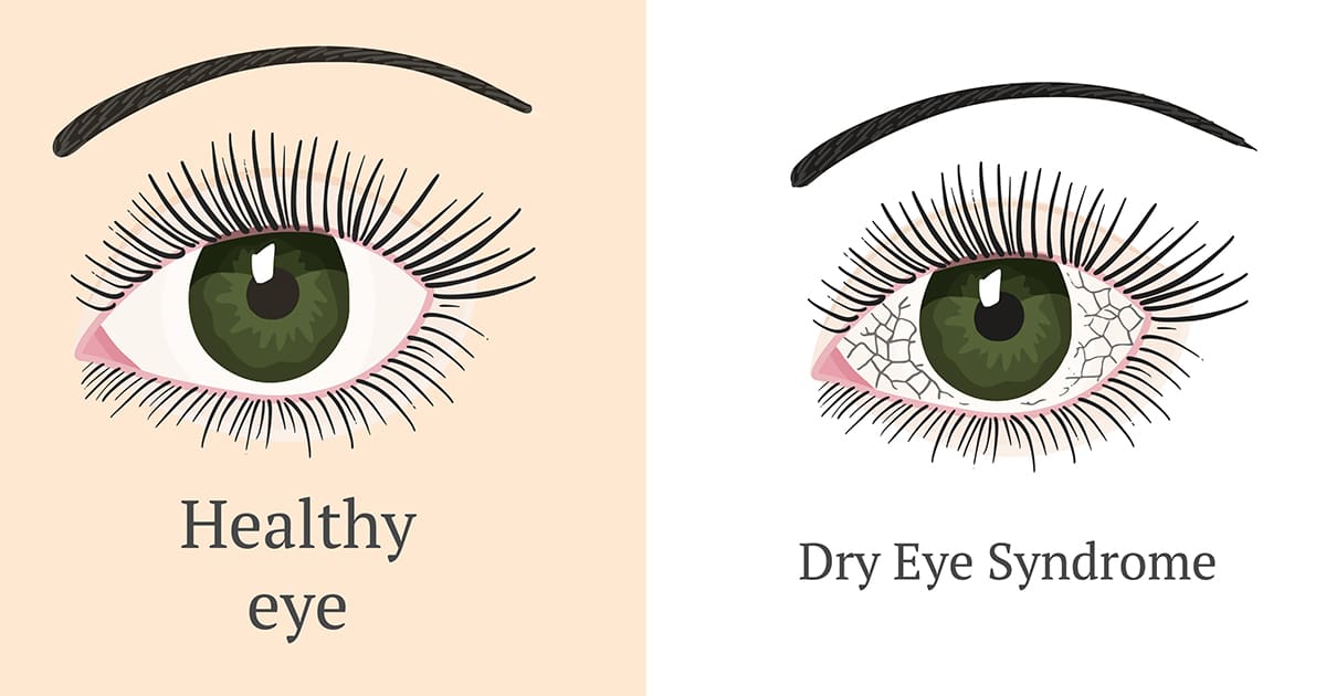 comparison of healthy eye and dry eyes