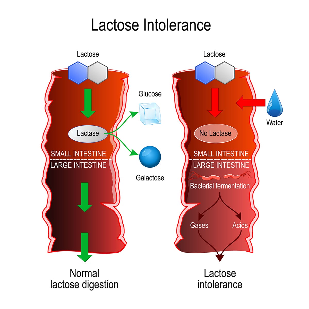 illustration of normal lactose digestion and lactose intolerance