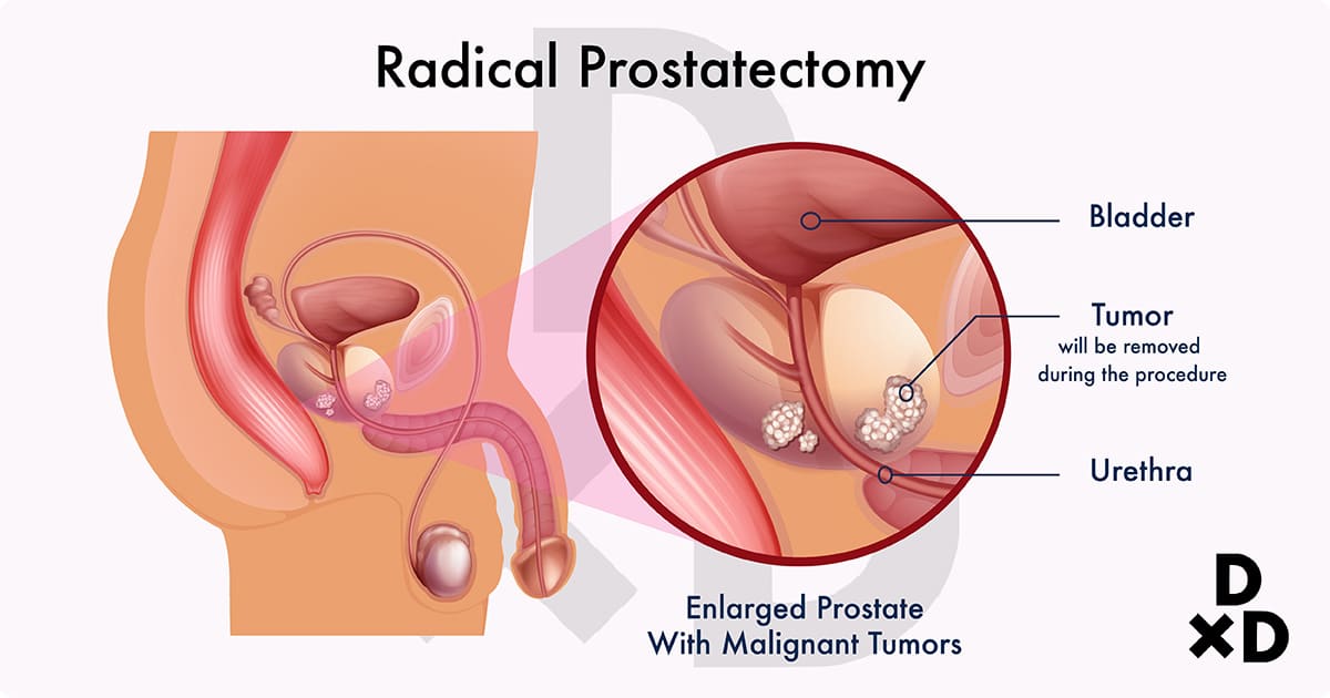 illustration of radical prostatectomy on enlarged prostate with malignant tumors