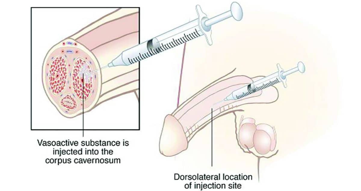 illustration of intracavernosal injection