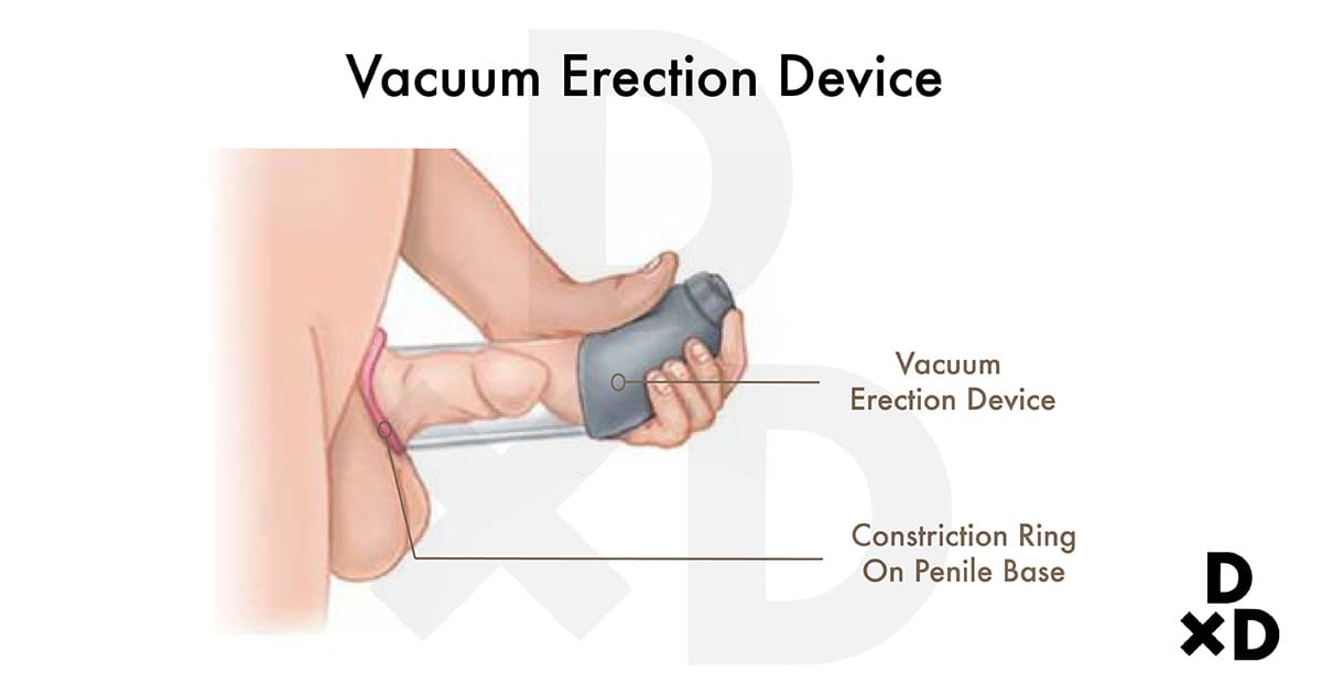 illustration of vacuum erection device