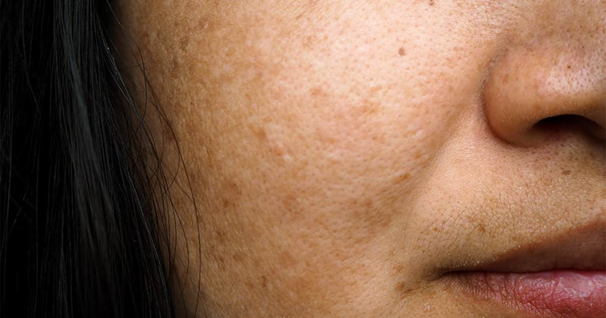 female-melasma